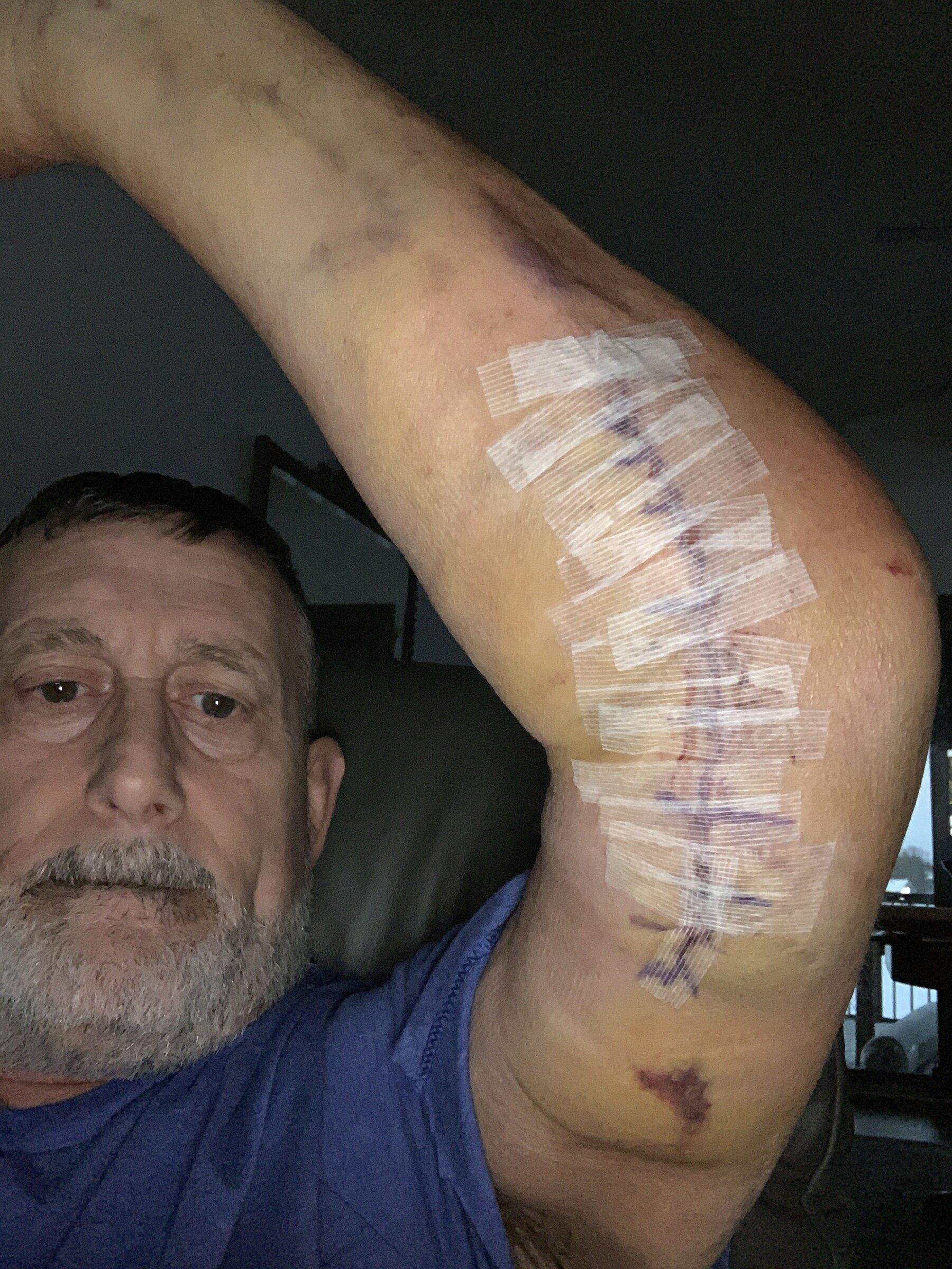 Jeep Gladiator Stuck in hospital for week after getting new Mojave. Inside of elbow